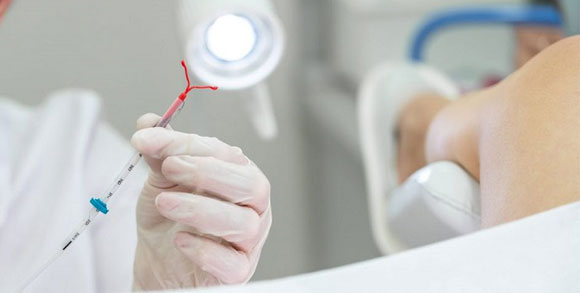 Hỏi đáp Bác sĩ: Đặt vòng tránh thai có đau không?