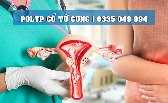 Polyp cổ tử cung – Làm sao để phát hiện chính xác bệnh?